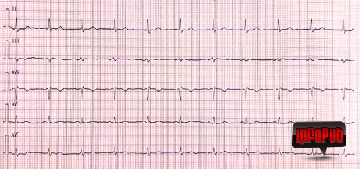 Electrocardiograma si evitarea erorilor de inregistrare