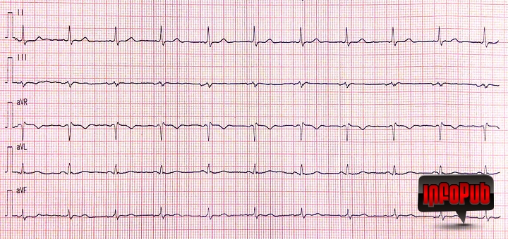 Electrocardiograma si evitarea erorilor de inregistrare Electrocardiograma si evitarea erorilor de inregistrare